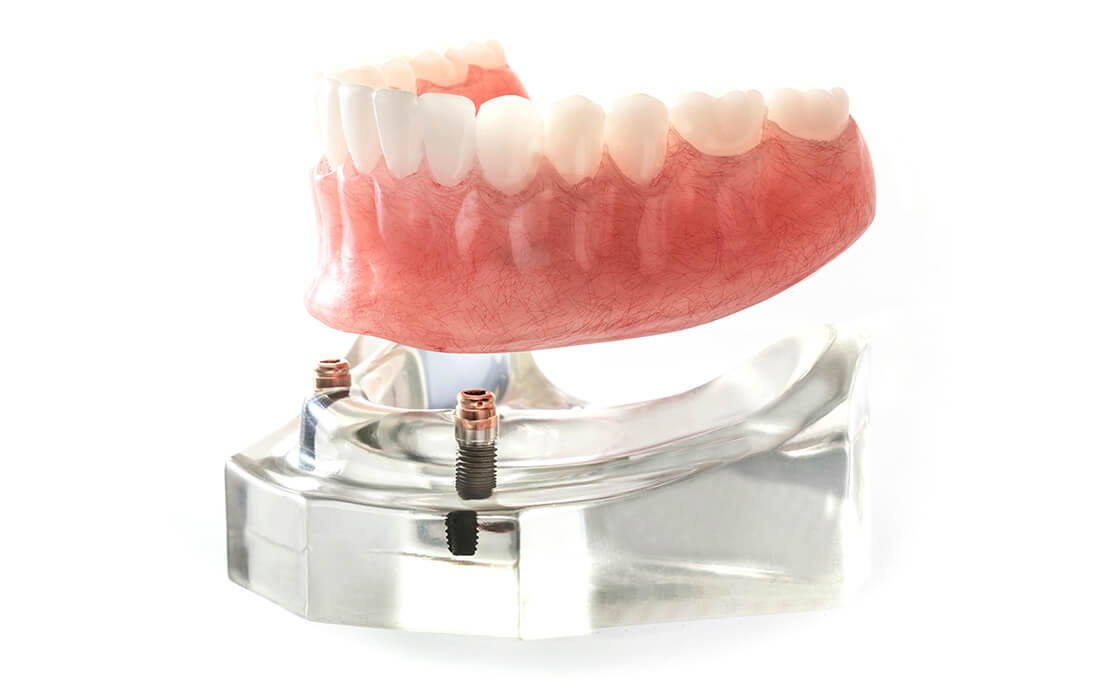 マグネットデンチャー(磁性アタッチメント)