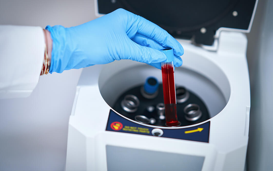 PRP(多血小板血漿)骨再生療法